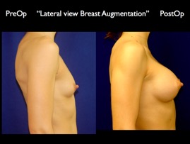 Breast-Aug.021.jpg