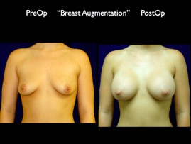 Breast-Aug.022.jpg