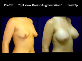 Breast-Aug.023.jpg