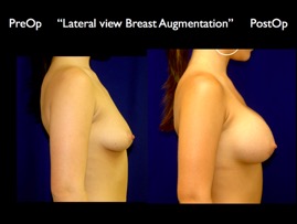 Breast-Aug.024.jpg