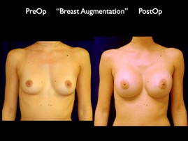 Breast-Aug.025.jpg
