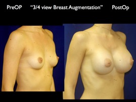 Breast-Aug.026.jpg