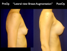 Breast-Aug.027.jpg