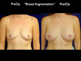 Breast-Aug.028.jpg
