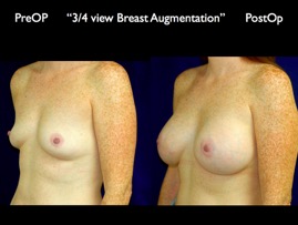 Breast-Aug.029.jpg