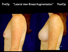 Breast-Aug.030.jpg