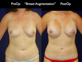 Breast-Aug.031.jpg