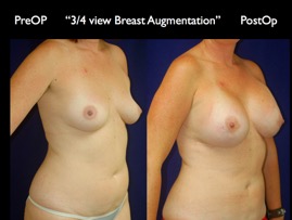 Breast-Aug.032.jpg