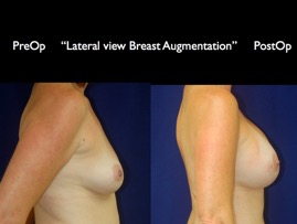 Breast-Aug.033.jpg