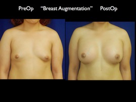 Breast-Aug.034.jpg