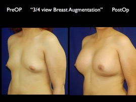 Breast-Aug.035.jpg