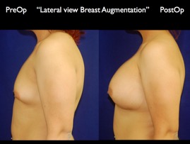Breast-Aug.036.jpg