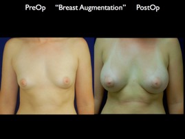 Breast-Aug.037.jpg