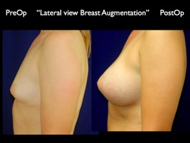 Breast-Aug.039.jpg