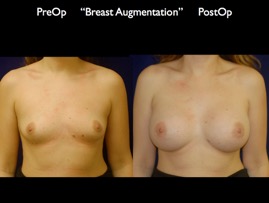 Breast-Aug.040.jpg