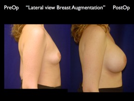 Breast-Aug.042.jpg
