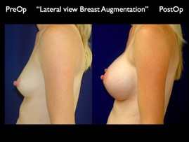 Breast-Aug.045.jpg