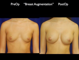 Breast-Aug.046.jpg