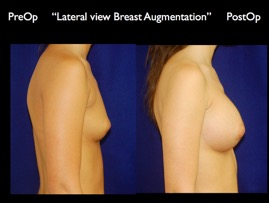 Breast-Aug.048.jpg