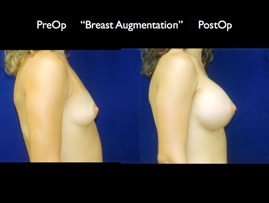 Breast-Aug2.003.jpg