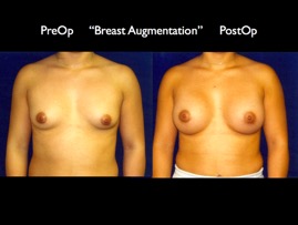 Breast-Aug2.004.jpg