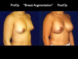 Breast-Aug2.005.jpg