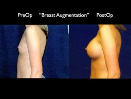 Breast-Aug2.009.jpg