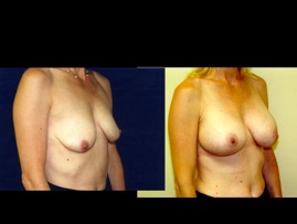 Breast-Aug2.010.jpg