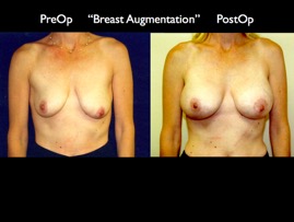 Breast-Aug2.011.jpg