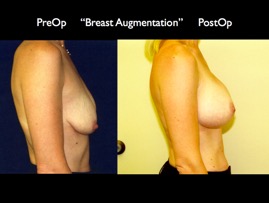 Breast-Aug2.012.jpg