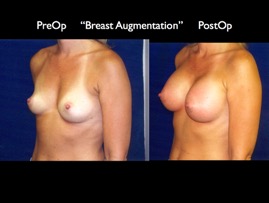 Breast-Aug2.013.jpg