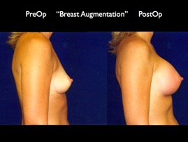 Breast-Aug2.015.jpg