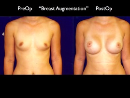 Breast-Aug2.017.jpg