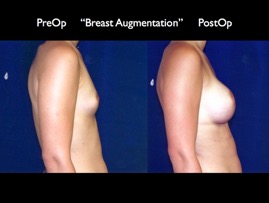 Breast-Aug2.018.jpg