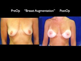 Breast-Aug2.020.jpg