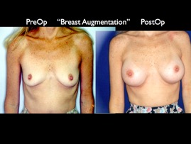Breast-Aug2.024.jpg