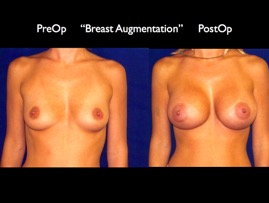 Breast-Aug2.028.jpg