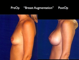 Breast-Aug2.030.jpg