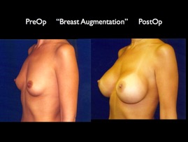 Breast-Aug2.031.jpg