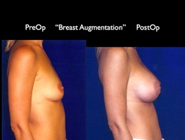 Breast-Aug2.032.jpg