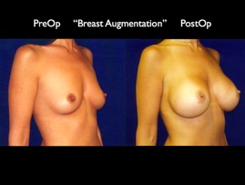 Breast-Aug2.033.jpg