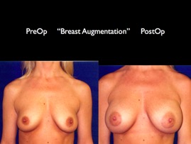 Breast-Aug2.034.jpg