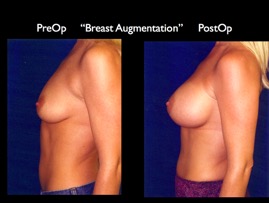 Breast-Aug2.036.jpg