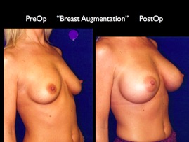 Breast-Aug2.037.jpg