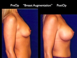 Breast-Aug2.038.jpg