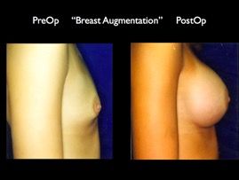 Breast-Aug2.041.jpg