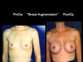 Breast-Aug2.043.jpg