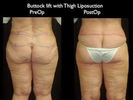 Butt-Lift.011.jpg