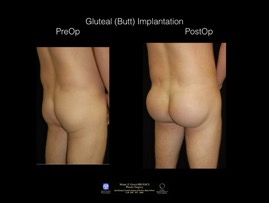Butt-Imp-pos-II.004.jpg