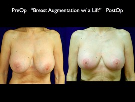 Aug-Lift.001.jpg